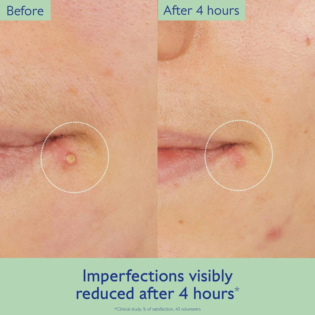 Targeted Spot Solution with Salicylic Acid
