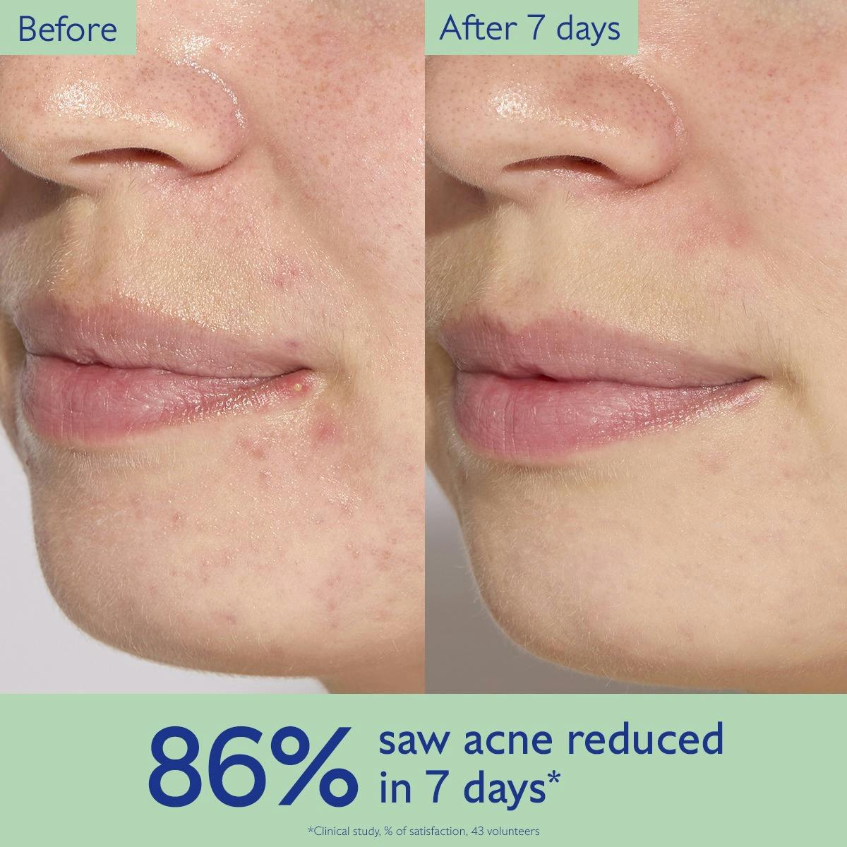 Acne Serum to Treat and Prevent Blemishes