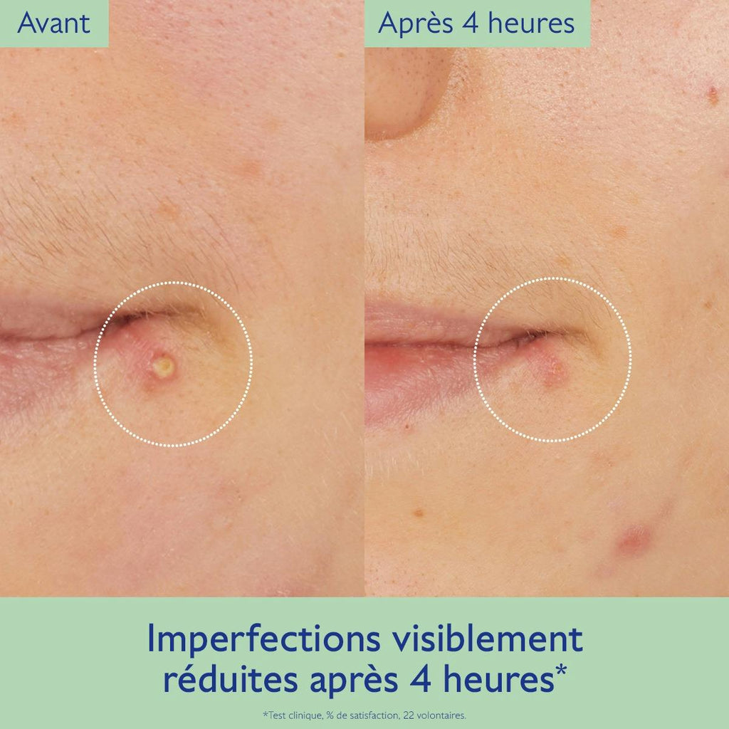 Targeted Spot Solution with Salicylic Acid