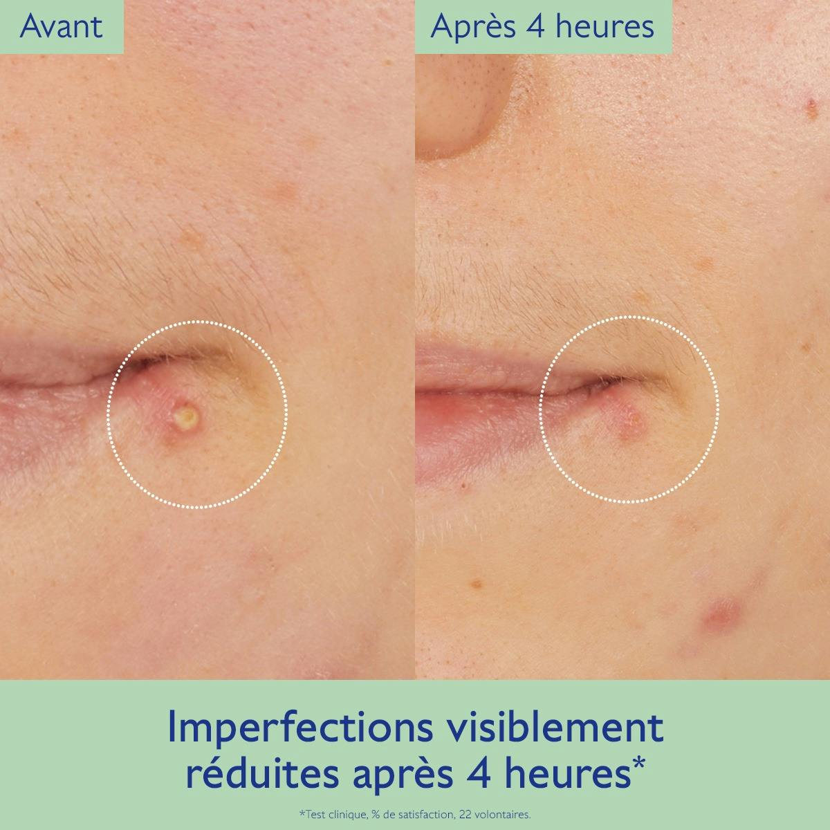 Targeted Spot Solution with Salicylic Acid