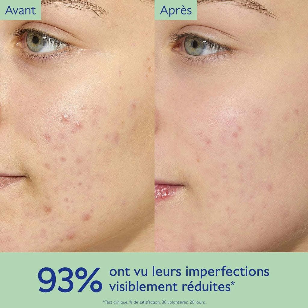 Oil-Control Moisturizer for Acne Prone Skin