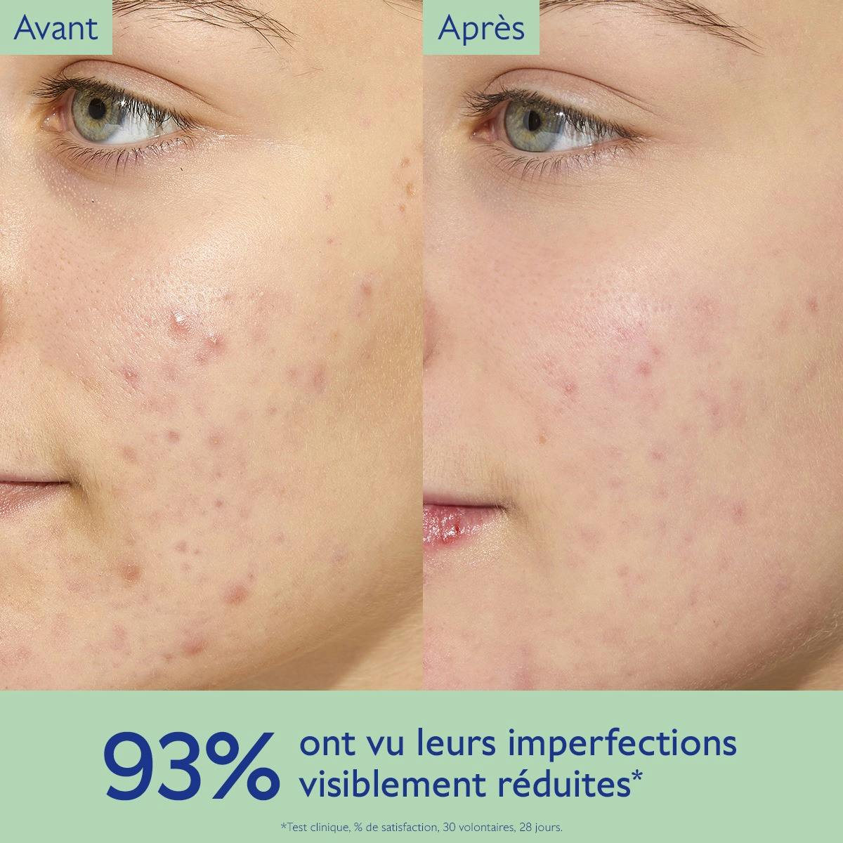 Oil-Control Moisturizer for Acne Prone Skin